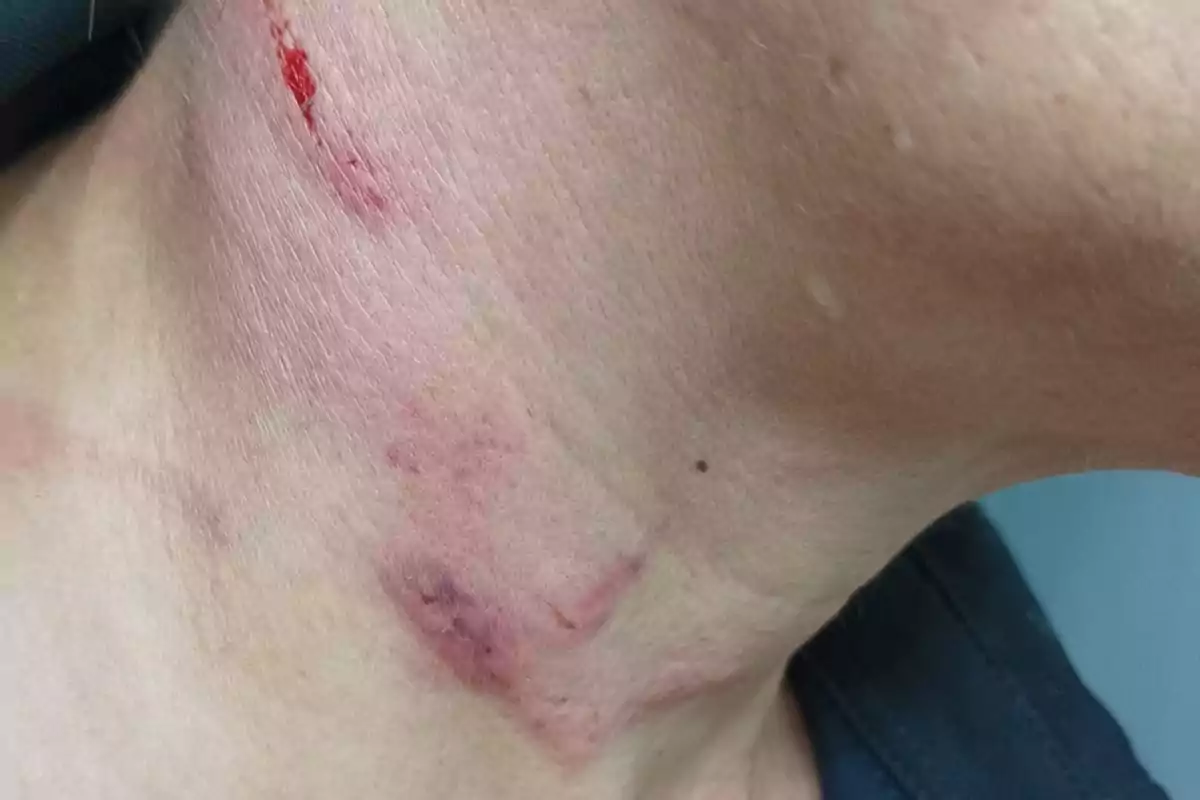 Cuello de una persona con moretones y una herida superficial en la piel Cuello de una persona con moretones y una herida superficial en la piel