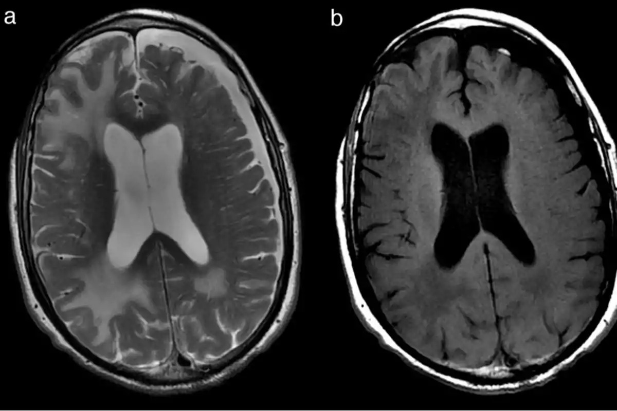 Dos imágenes de resonancia magnética del cerebro, una a la izquierda con mayor contraste y otra a la derecha con menor contraste, mostrando estructuras internas.