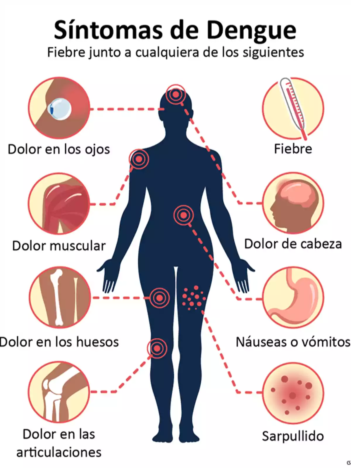 Síntomas de dengue: fiebre, dolor en los ojos, dolor muscular, dolor en los huesos, dolor en las articulaciones, dolor de cabeza, náuseas o vómitos, sarpullido.
