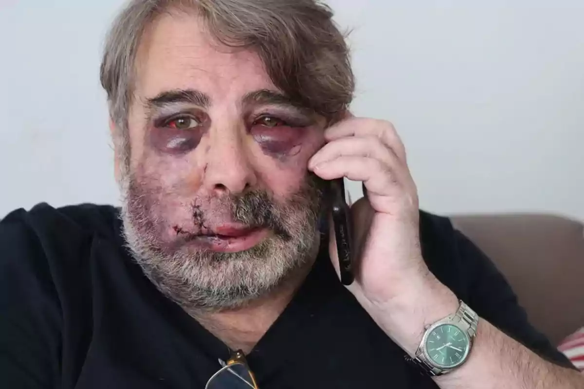 Un hombre con el rostro visiblemente golpeado y moretones alrededor de los ojos está hablando por teléfono.