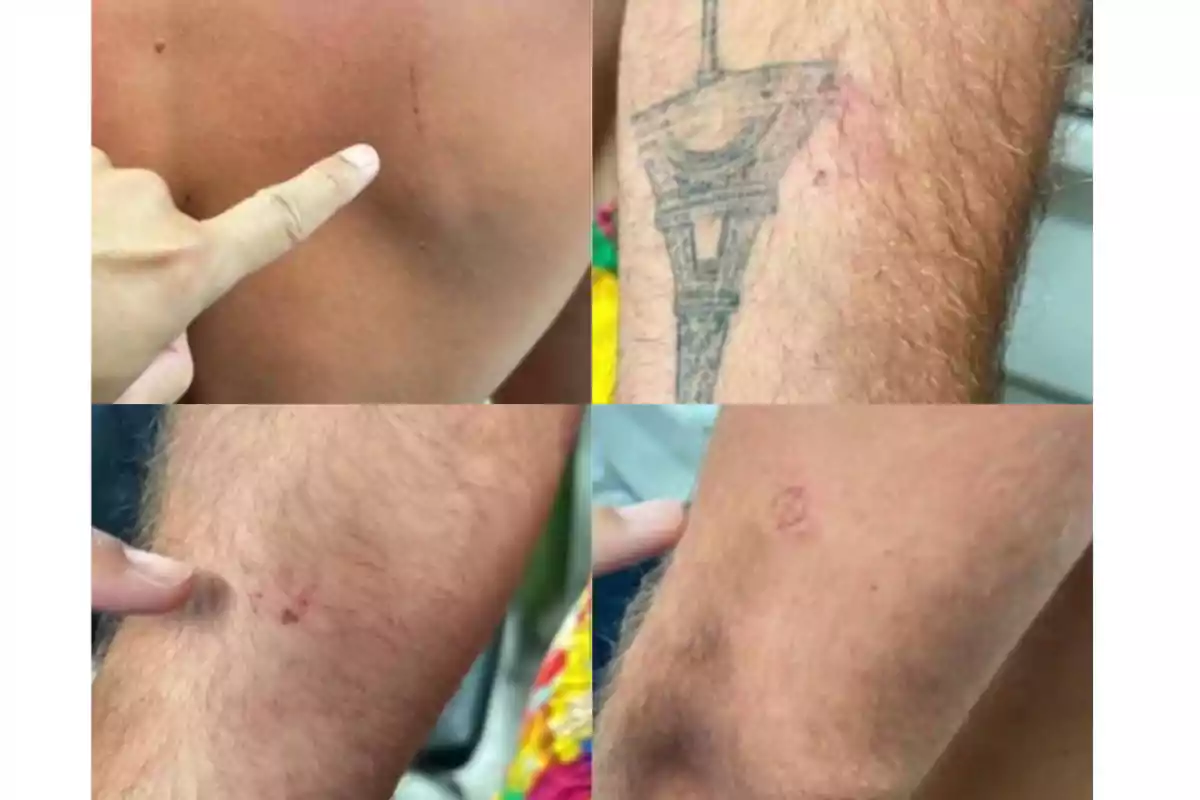 Imagen que muestra varias lesiones en la piel de una persona, incluyendo rasguños y marcas rojas en la espalda y los brazos, con un tatuaje visible en uno de los brazos.