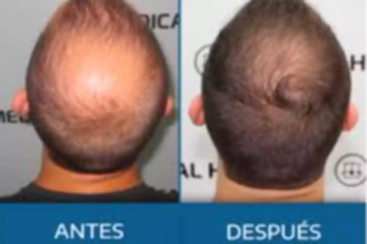 Una comparación de la parte posterior de la cabeza de una persona antes y después de un tratamiento capilar, mostrando una mejora en la densidad del cabello.