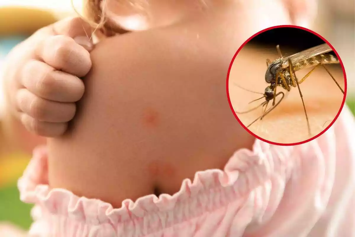 Montaje de una foto de una niña con picaduras de mosquitos y una imagen en un marco de un mosquito Montaje de una foto de una niña con picaduras de mosquitos y una imagen en un marco de un mosquito