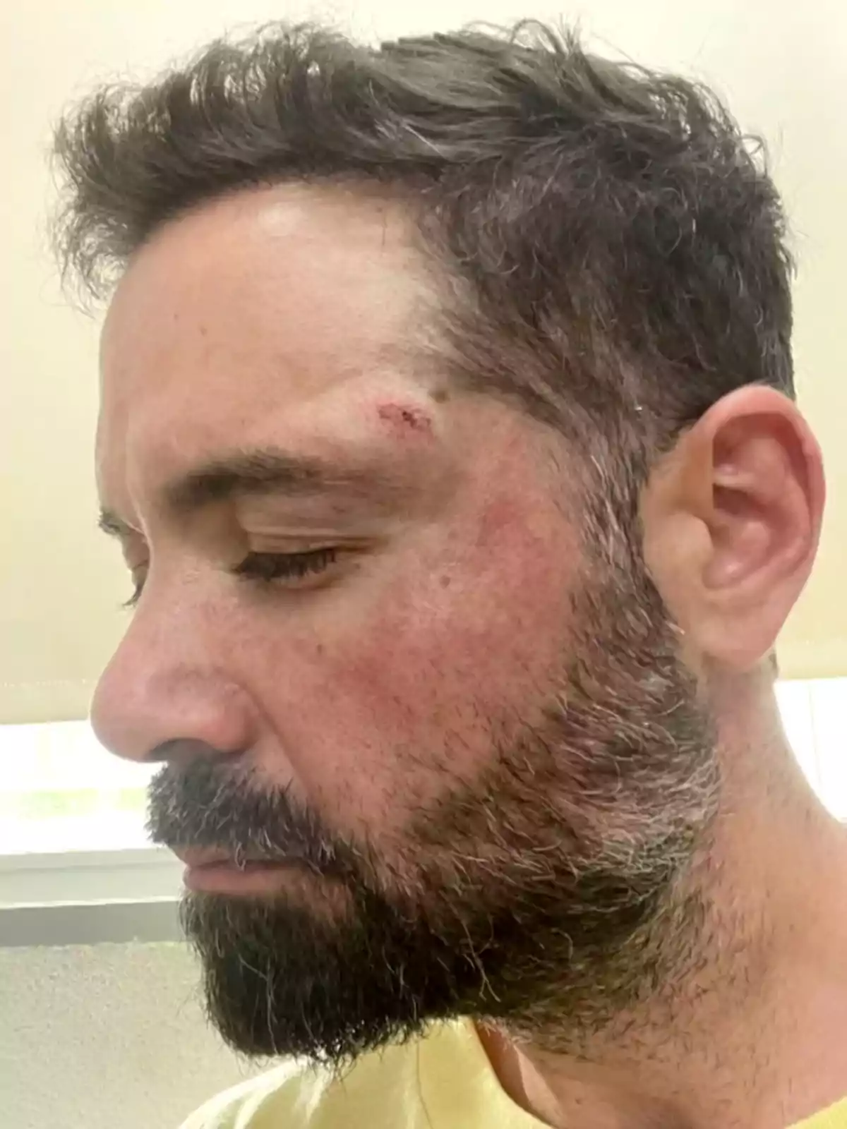 Un hombre con barba y cabello corto muestra una herida en la frente.