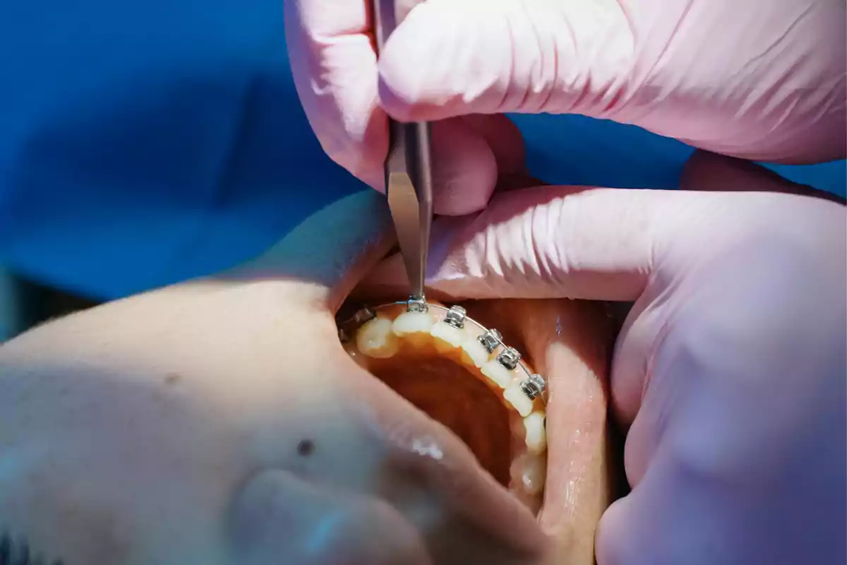 Dentista ajustando brackets en los dientes de un paciente.