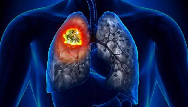 El cáncer de pulmón es el tipo de tumor más frecuente en todo el mundo, pero ahora hay más esperanzas de cura.  