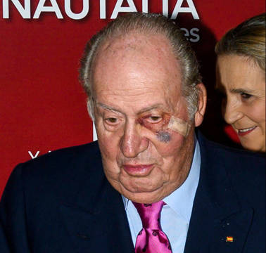 Don Juan Carlos apareció en Las Ventas con un ojo morado tras una operación leve