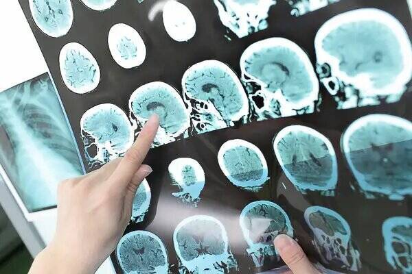 Escáner de un cerebro con esclerosis múltiple