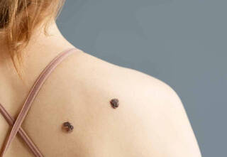 Día Mundial del Melanoma: El cáncer de piel más peligroso que aumenta su presencia en nuestro país