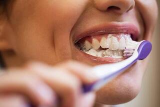 Alimentos que reducen la formación de sarro en los dientes